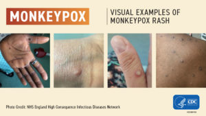 monkeypox cdc